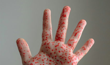 Sarampión: ¿cuáles son los síntomas, el contagio y qué se debe hacer para prevenirlo?