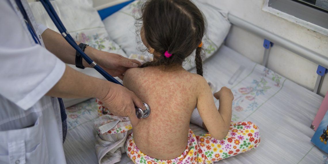 Ministerio de Salud refuerza acciones de vigilancia y control ante casos de sarampión